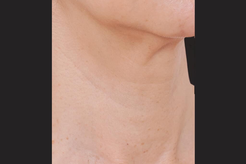 profhilo neck after