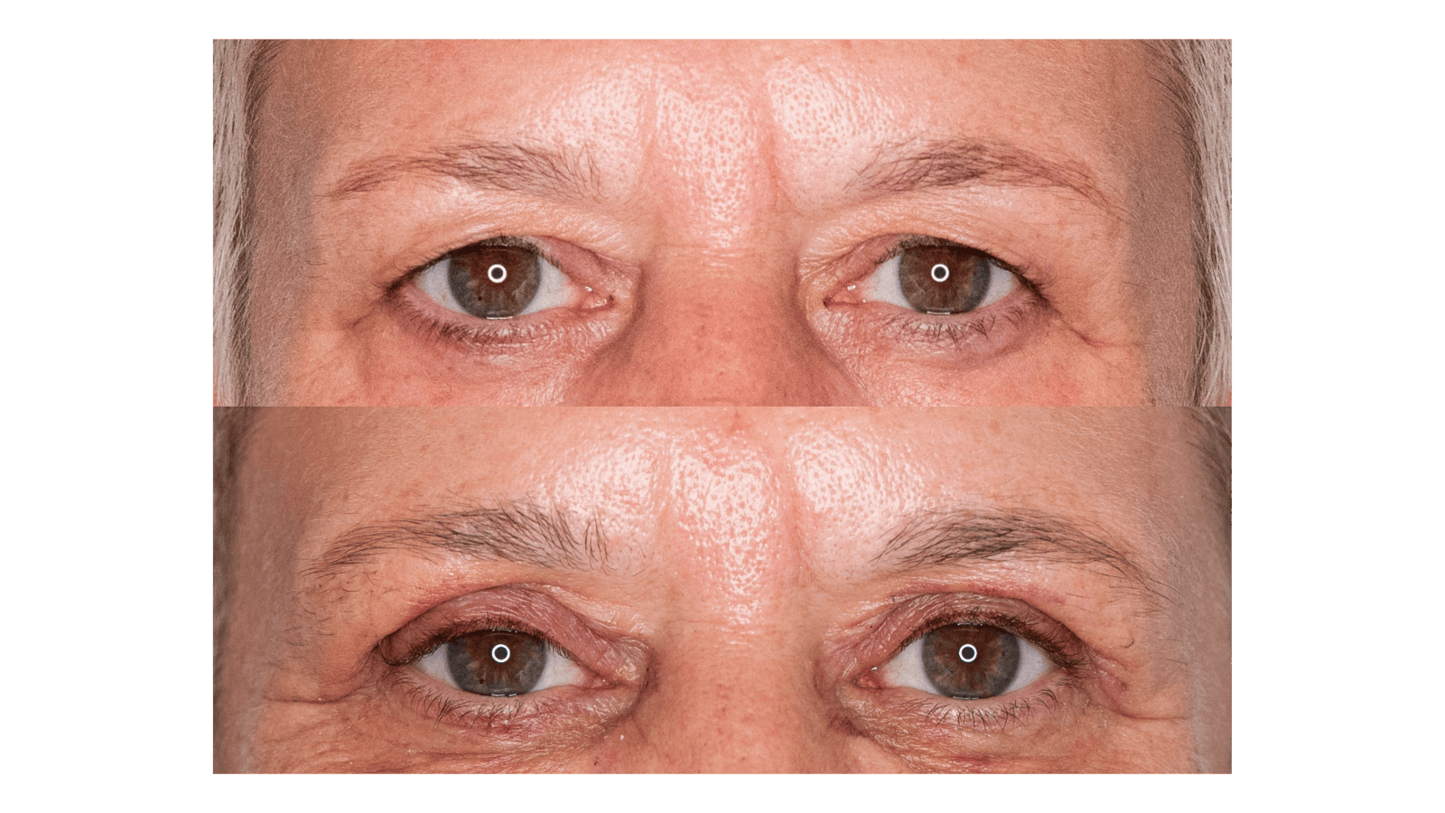 boc voor en na the body clinic